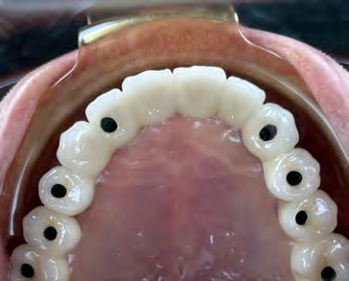 Fig. 3d: Occlusal view following insertion of the maxillary implant-supported fixed prosthesis, demonstrating passive fit on the eight implant abutments.
