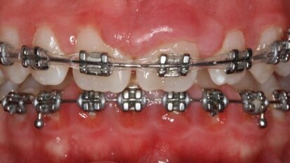 Stałe zdrowie jamy ustnej – estetyczna ortodoncja 30+