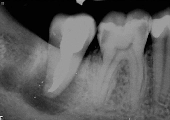 Fig. 18c: Radiographs: One-month recall, after endodontic treatment.