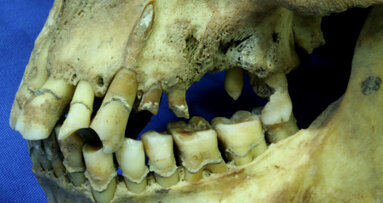 Heavy smoking during Irish famine led to dental caries, study finds