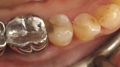 Restauration de classe II avec du composite thermo visqueux