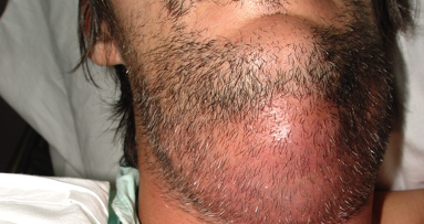 Manejo y prevención de infecciones odontogénicas