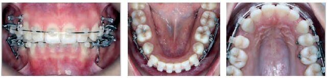 6 months later (at 17 months)