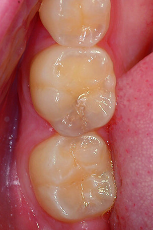 Initial Case. Proximal caries on the distal area of the first lower molar.