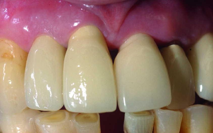 Figs. 17a et b : Vues cliniques de face et palatine. Notez la bonne adaptation des tissus mous. 