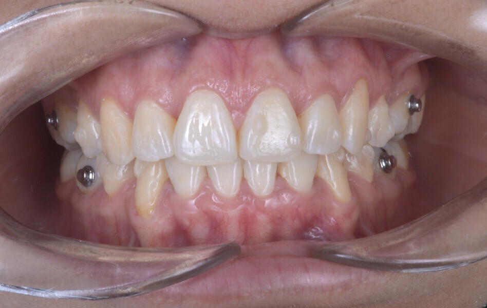 Fig. 6a: Intra-oral and occlusal photographs during treatment (after the 32nd aligner pair).