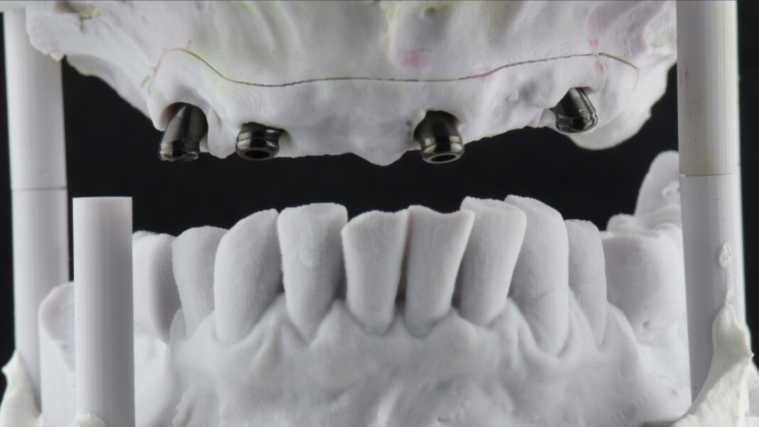 Fig. 11_Modelli stampati con pin di posizione, utilizzati in articolatore o come riferimento statico.