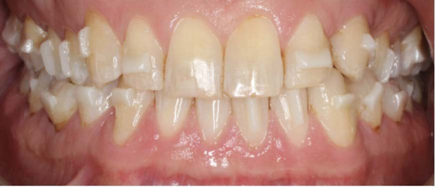 Fig. 6: Clarity Precision Grip Attachments bonded in the mouth.