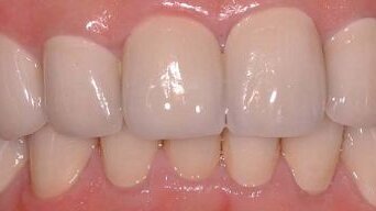 Management of full mouth prosthodontic rehabilitation using high-strength CAD/CAM zirconium-oxide crowns
