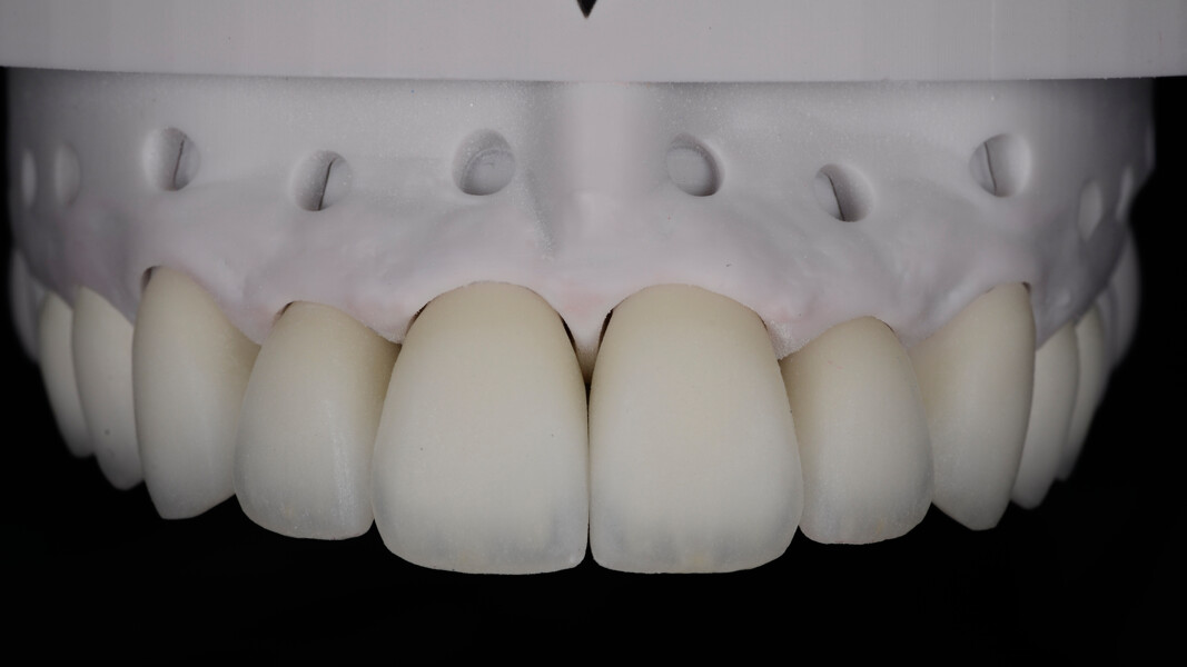 Fig. 23: Restorations after contouring, hand polishing and self-glaze firing.