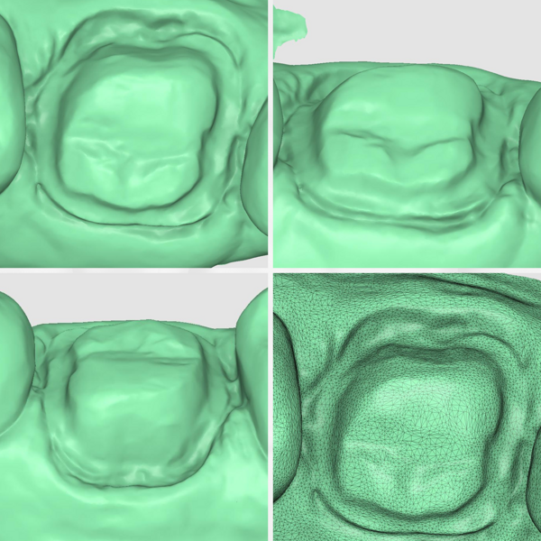 Fig. 7: Preparation margins on the Aoralscan 3 scan.
