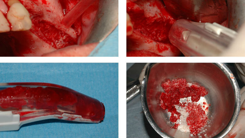 Protezione della membrana sinusale nell’esecuzione del rialzo di seno con innesti ossei eterologhi