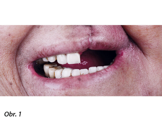 Výchozí situace s chybějící levou částí maxily