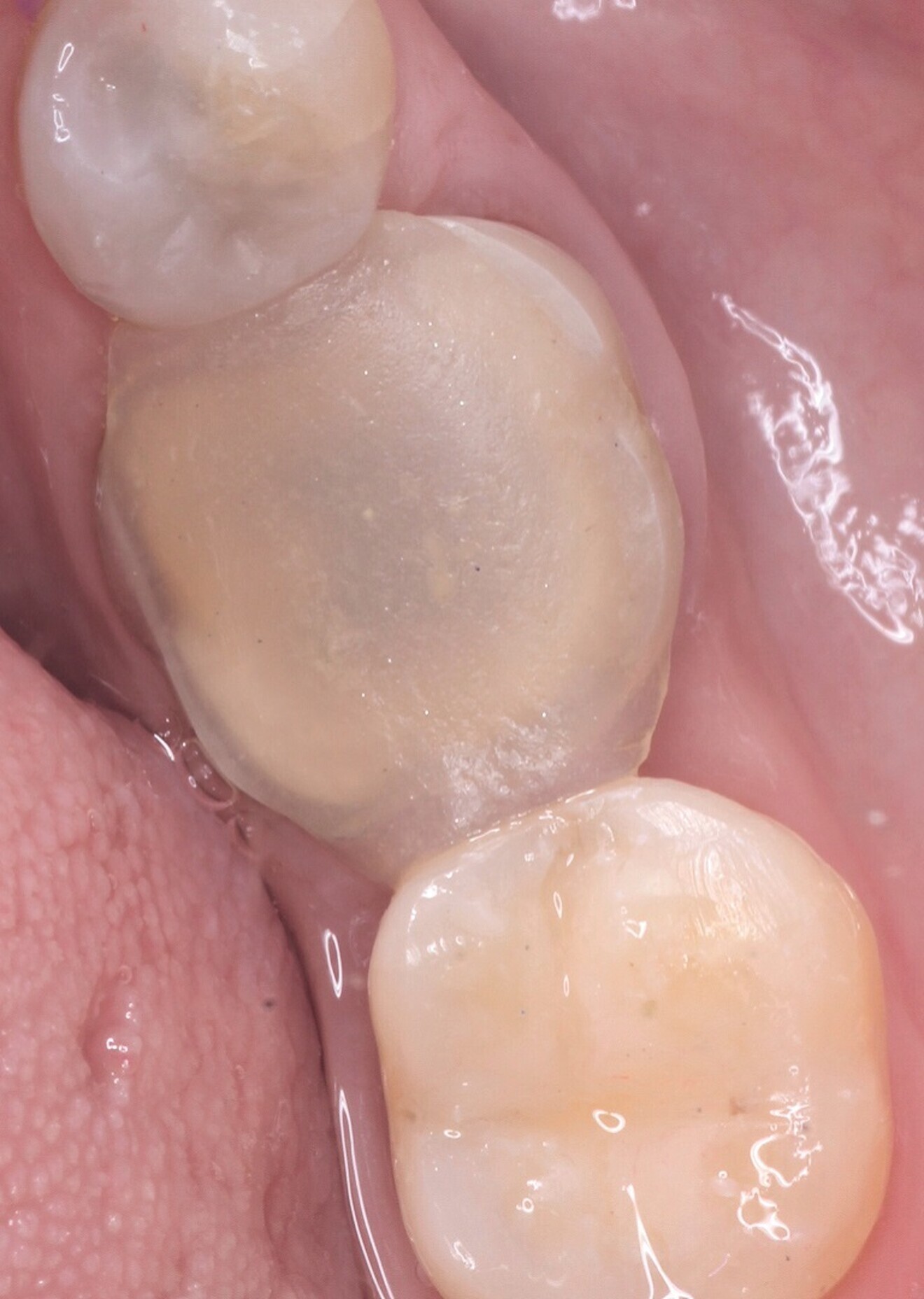 Fig. 8: Clip F temporary filling to allow the patient to rest during the milling process.