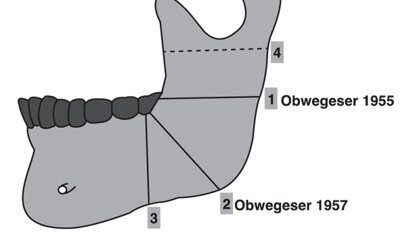 Orthodontic surgery and aesthetics