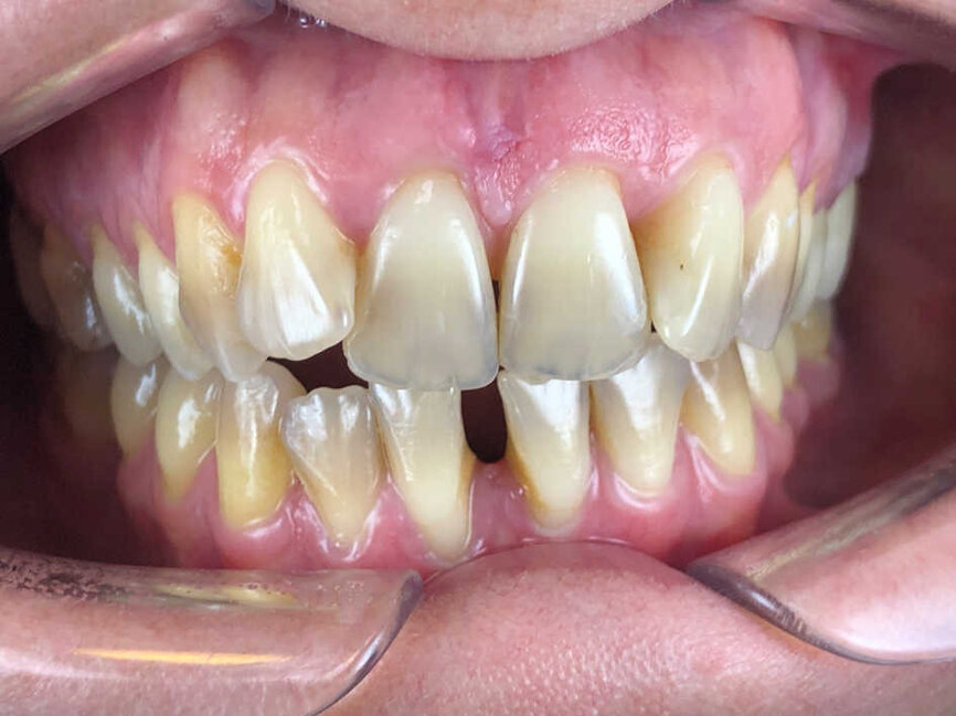 Photo de face début de traitement (Copyright- Dr Edouard Negre)