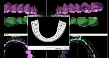 Systemy CAD/CAM w zabiegach korekcyjnych szczęk w chirurgii ortognatycznej