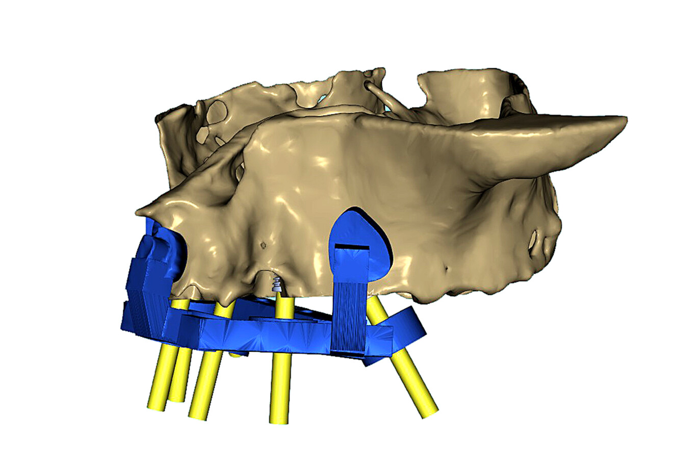 Fig. 8a: Simulation of the maxillary surgical guide in place. Left lateral view showing the anterior and posterior rest seats and the posterior tilted implant visualised with a yellow abutment projection.