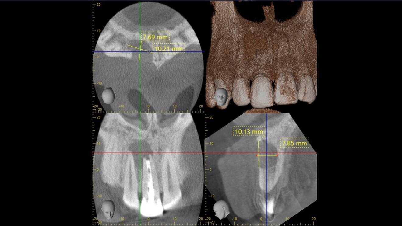 Fig. 3: Cystic cavity measuring approximately 10 × 8 mm.