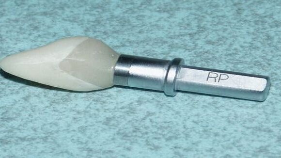 Remplacement immédiat d'une dent unitaire, provisionalisation