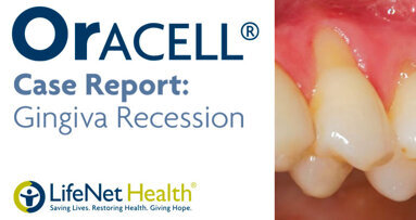 Patient with severe gum recession treated with Oracell. Patient with severe gum recession treated with Oracell.