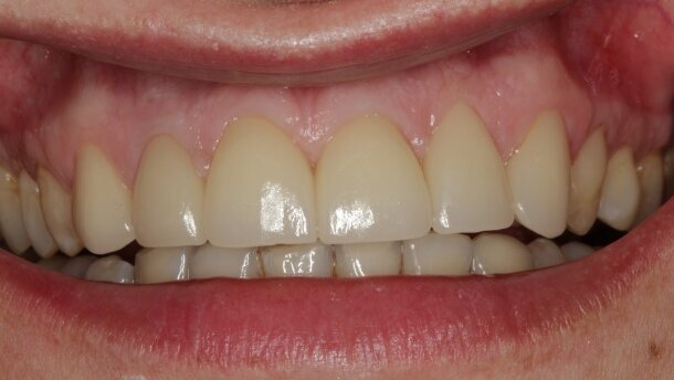 Przywrócenie estetyki uśmiechu w odcinku przednim szczęki przy pomocy technologii CAD/CAM