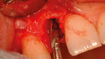 Tecnica post-estrattiva: i suoi vantaggi
