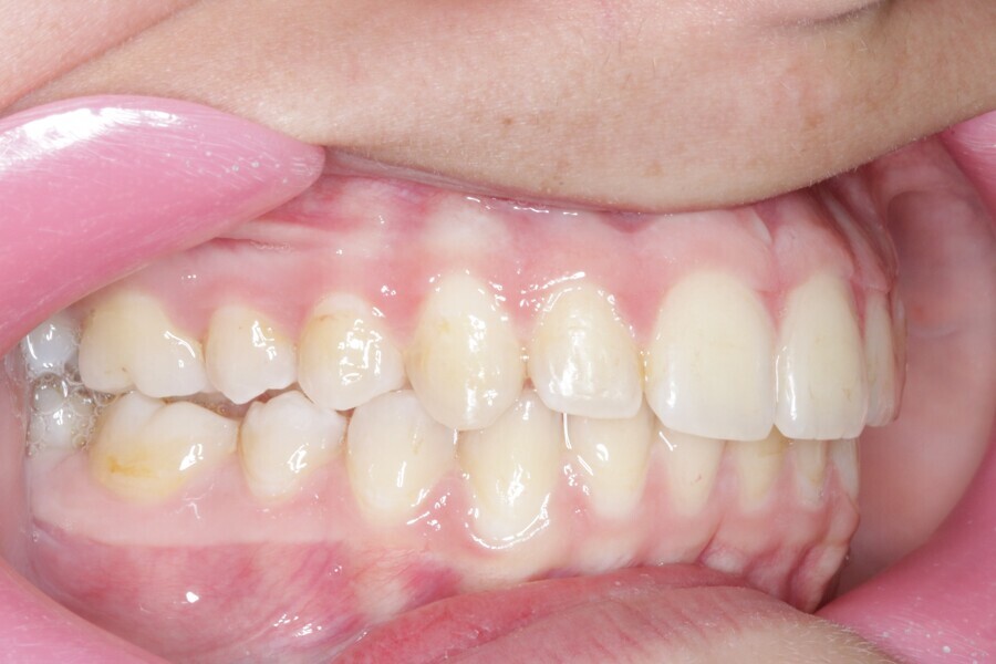 Fig. 24: Final situation after 25 Reveal aligners.