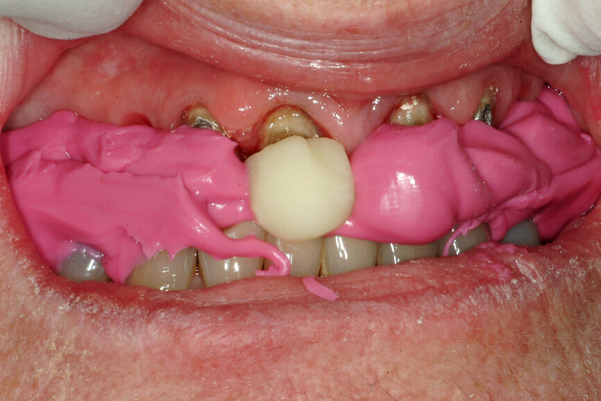 Fig. 23: Analogue recording of centric relation using a composite device to stabilise the mandible and polyvinylsiloxane recording paste.