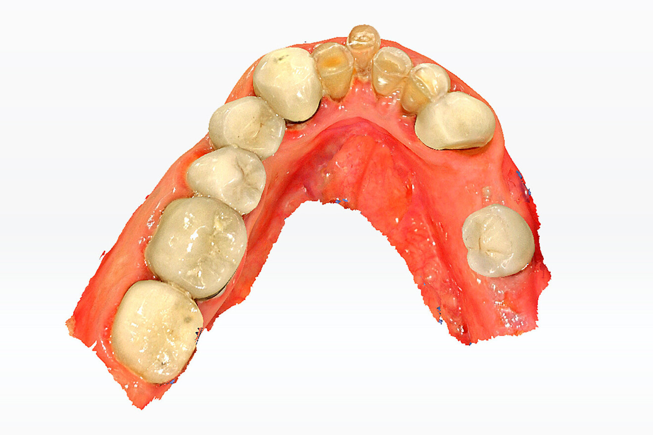 Fig. 3d: Occlusal view of the maxillary arch.