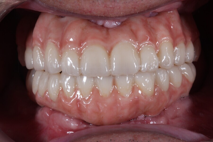 Fig. 18: Final prostheses of monolithic KATANA Zirconia YML, stained using CERABIEN ZR FC Paste Stain. The dark gingiva spots were stained with the shade Red, the light pink surfaces with the shade Pink and the highlights with the shade Salmon Pink.