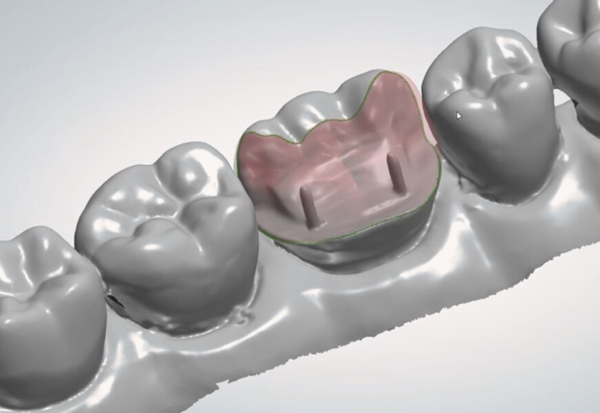 Fig. 15b: The scanned preparation with the dentine pins.
