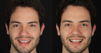 Restauración mínimamente invasiva con carillas de base cerámica