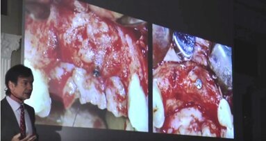 „Kierunki dla implantologii i inżynierii tkankowej” – powodzenie implantów maszynowych i GBR