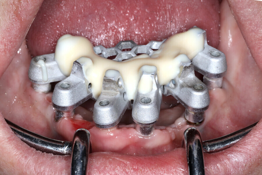 Fig. 15h: Grammetry OptiSplint used to capture implant positions for model fabrication.