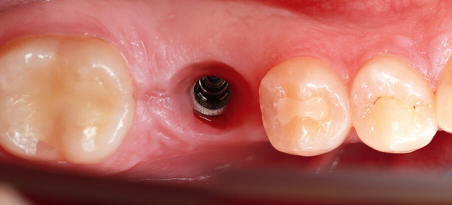 Fig. 31: After the extraction and implantation procedure, the site was ready for the new restoration.