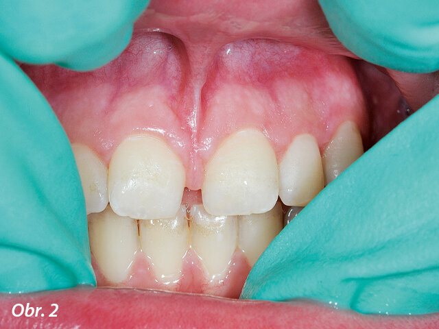 Iniciální situace ukazující diastema.