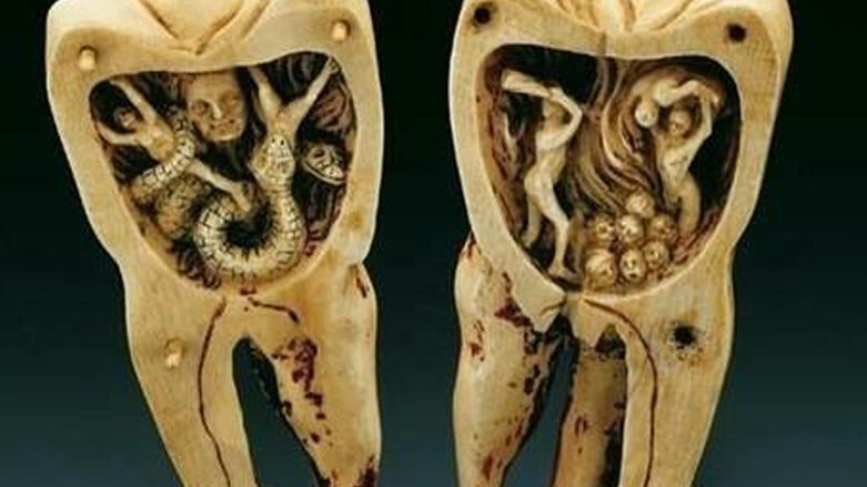 L’origine del mal di denti e la nascita della devitalizzazione
