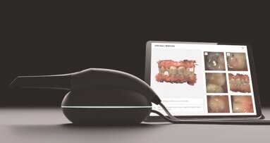 3DISC reinvents the intra-oral scanner with OVO