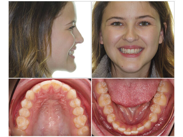 Počáteční fotografie  • Velké bukální koridory  • Nedostatečná expozice řezáků  • Malokluze I. třídy