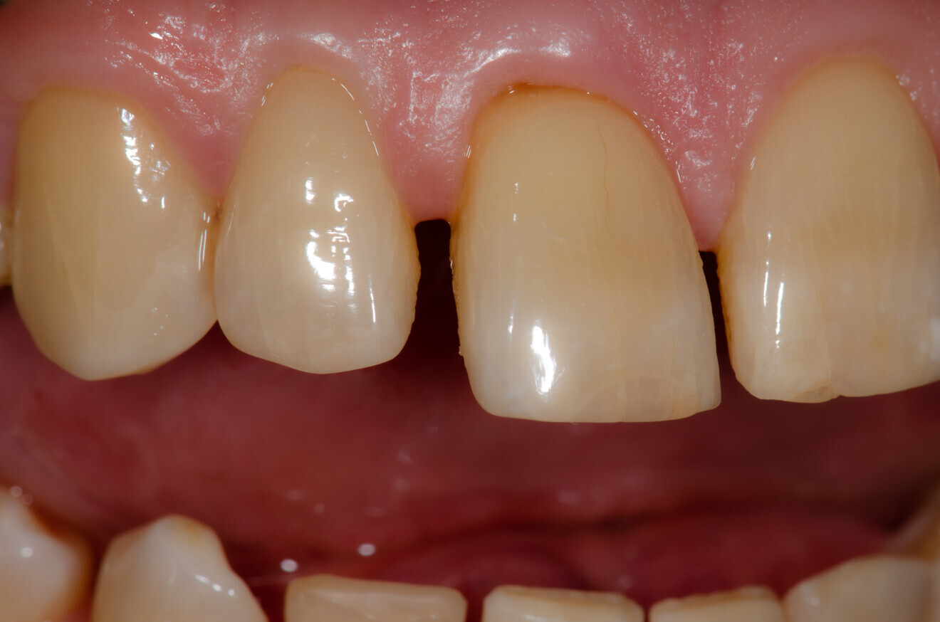Fig. 1b: Initial intra-oral photographs of tooth #11, lateral view.