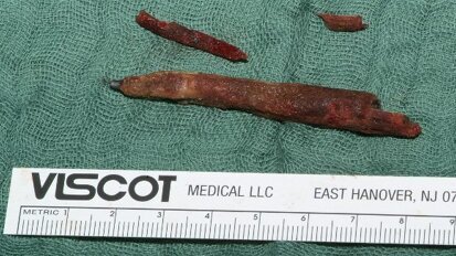 Homem vive com lápis no seio maxilar por anos