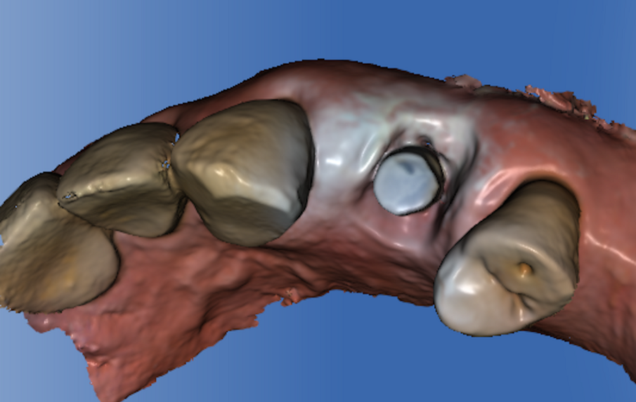Figg. 4a, 4b - Inserimento del moncone e presa dell’impronta digitale.
