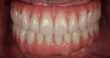 PEEK implant-supported prostheses to be discussed in webinar