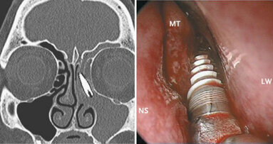 Dentaal implantaat verwijderd uit neusholte