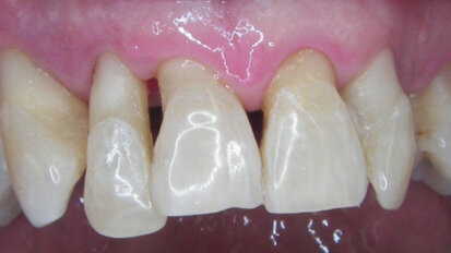 Indagine retrospettiva di follow-up a dieci anni dalla diagnosi e dal trattamento di parodontiti croniche e aggressive