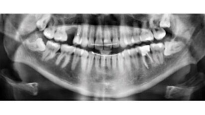 Retratamiento no quirúrgico de una perforación