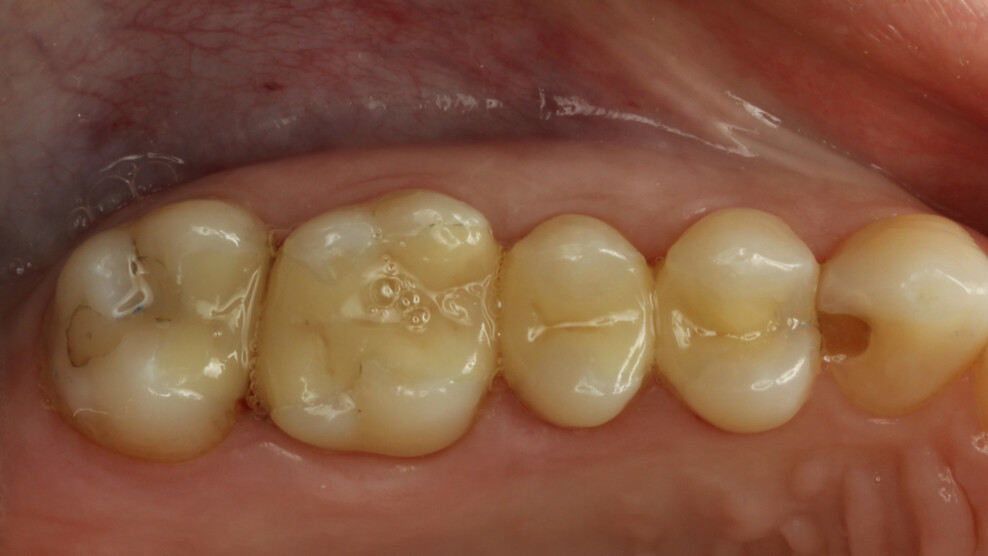 Fig. 7: Final result of all 3D-printed restorations cemented in the mouth.