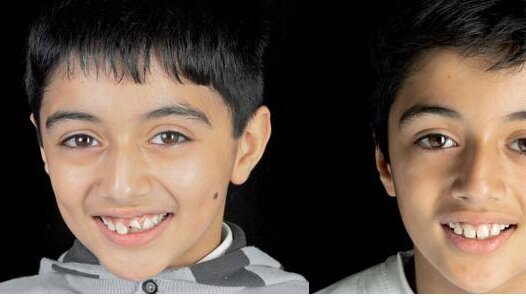 Lepljenje fragmenta i nadogradnja frakturiranog maksilarnog centralnog sekutića