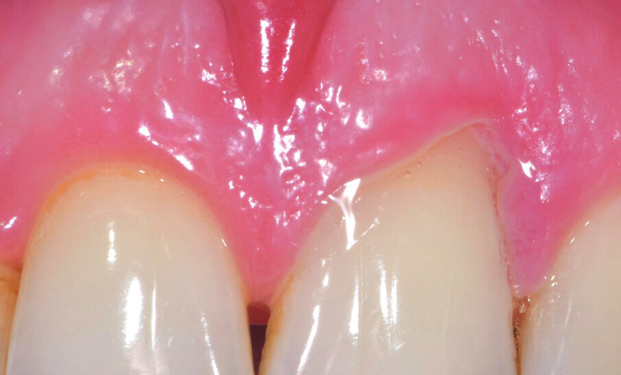 Fig. 4 - Guarigione a 2 sett. Notare la recessione dei tessuti dovuti ad una precedente strumentazione eccessiva.